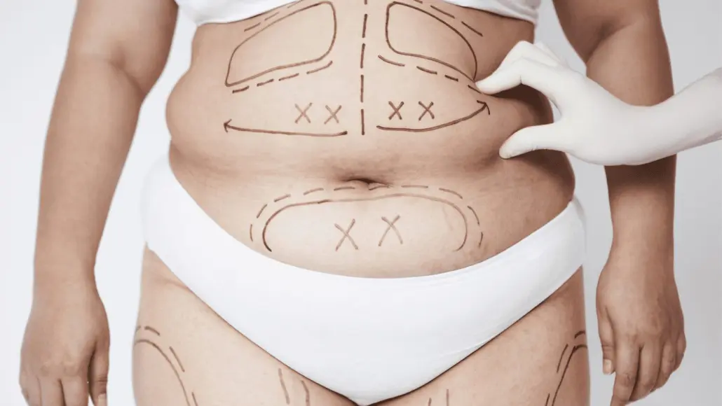 vibration bei stummschaltung iphone Neu bei uns: Liposuktion mit VASER® l Körperkonturierung main image 1