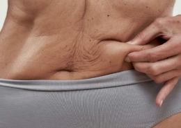 Symbolbild für das Thema Fettschürze entfernen: Es wird ein Bildabschitt von einem weiblichen Bauch mit einer Fettschürze gezeigt, bei dem sich die betreffende Frau in den Bauch greift