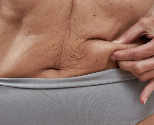 Symbolbild für das Thema Fettschürze entfernen: Es wird ein Bildabschitt von einem weiblichen Bauch mit einer Fettschürze gezeigt, bei dem sich die betreffende Frau in den Bauch greift