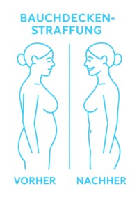 Illustration eines Vorher-Nachher-Vergleichs bei einer Bauchdeckenstraffung