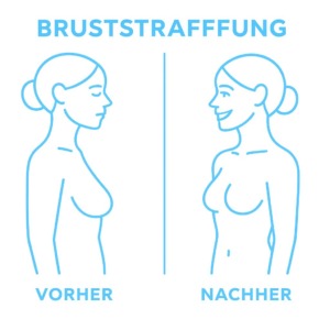 Vorhher-Nachher-Illustration bei einer Bruststraffung
