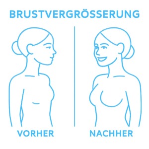 Illustration eines Vorher-Nachher-Vergleichs bei einer Brustvergrößerung