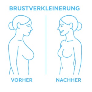 Illustration eines Vorher-Nachher-Vergleichs bei einer Brustverkleinerung