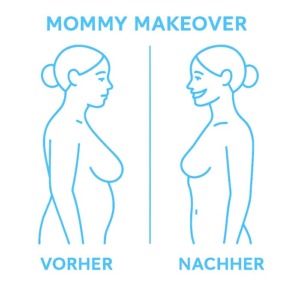 Illustration eines Vorher-Nachher-Vergleichs bei einem Mommy-Makeover