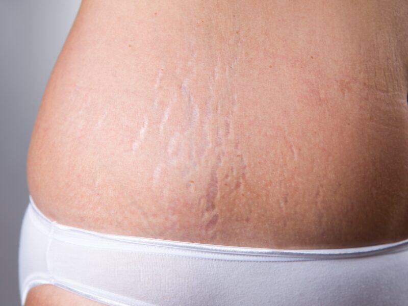 schwangerschaftsstreifen-entfernen-tipps-dr-kremer-thum