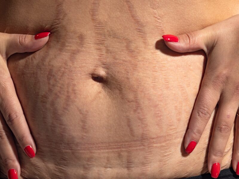 wie-entstehen-schwangerschaftsstreifen-dr-kremer-thum