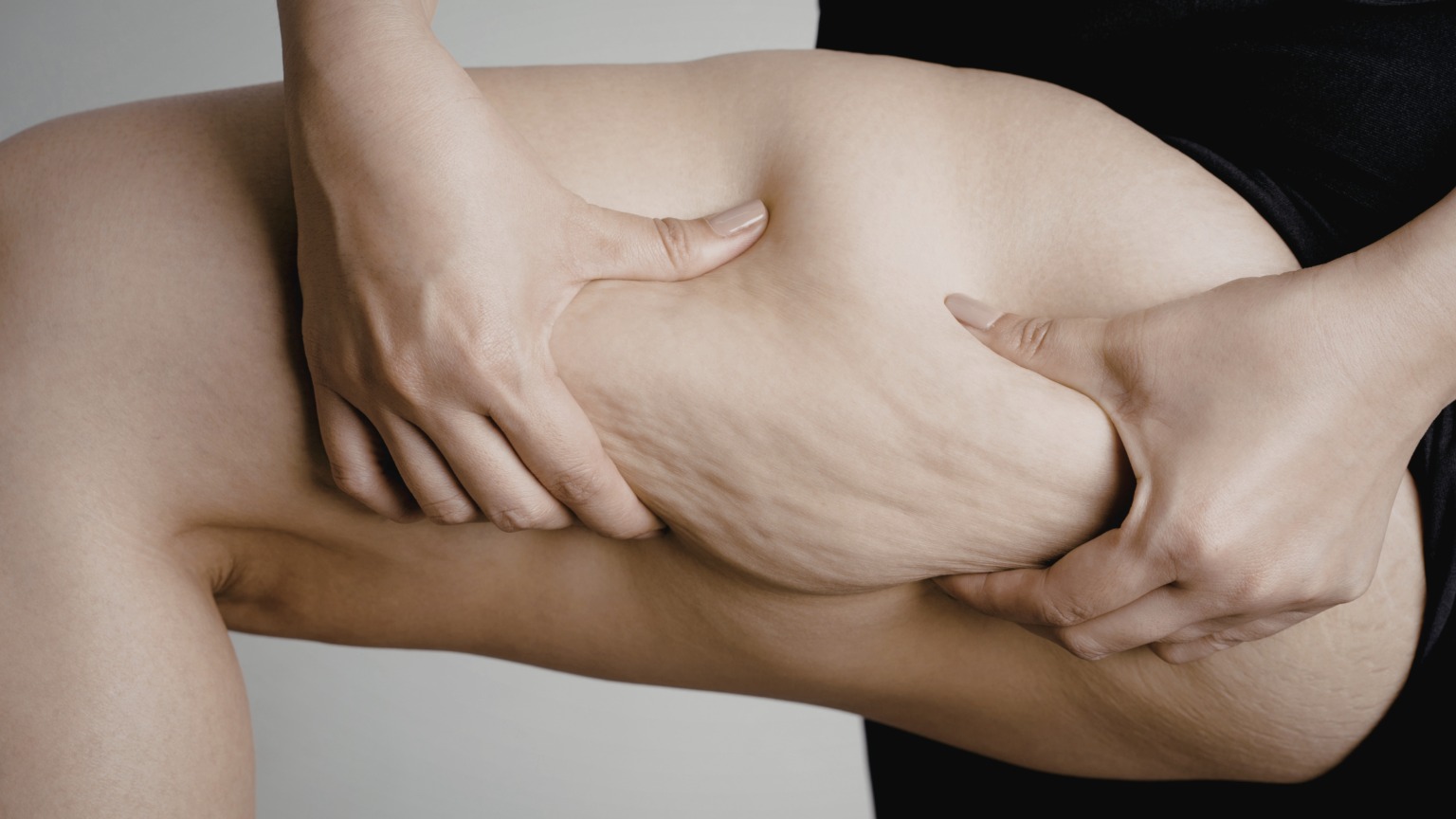 lipoedem-vs-normales-fett-unterschiede-dr-kremer-thum